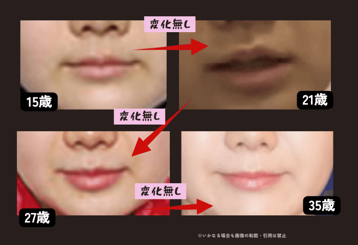 元卓球選手福原愛さんの唇の変化について時系列検証画像
以下4枚の画像

15歳（左上画像）
21歳（右上画像）
27歳（左下画像）
35歳（右下画像）

唇の変化は全くない